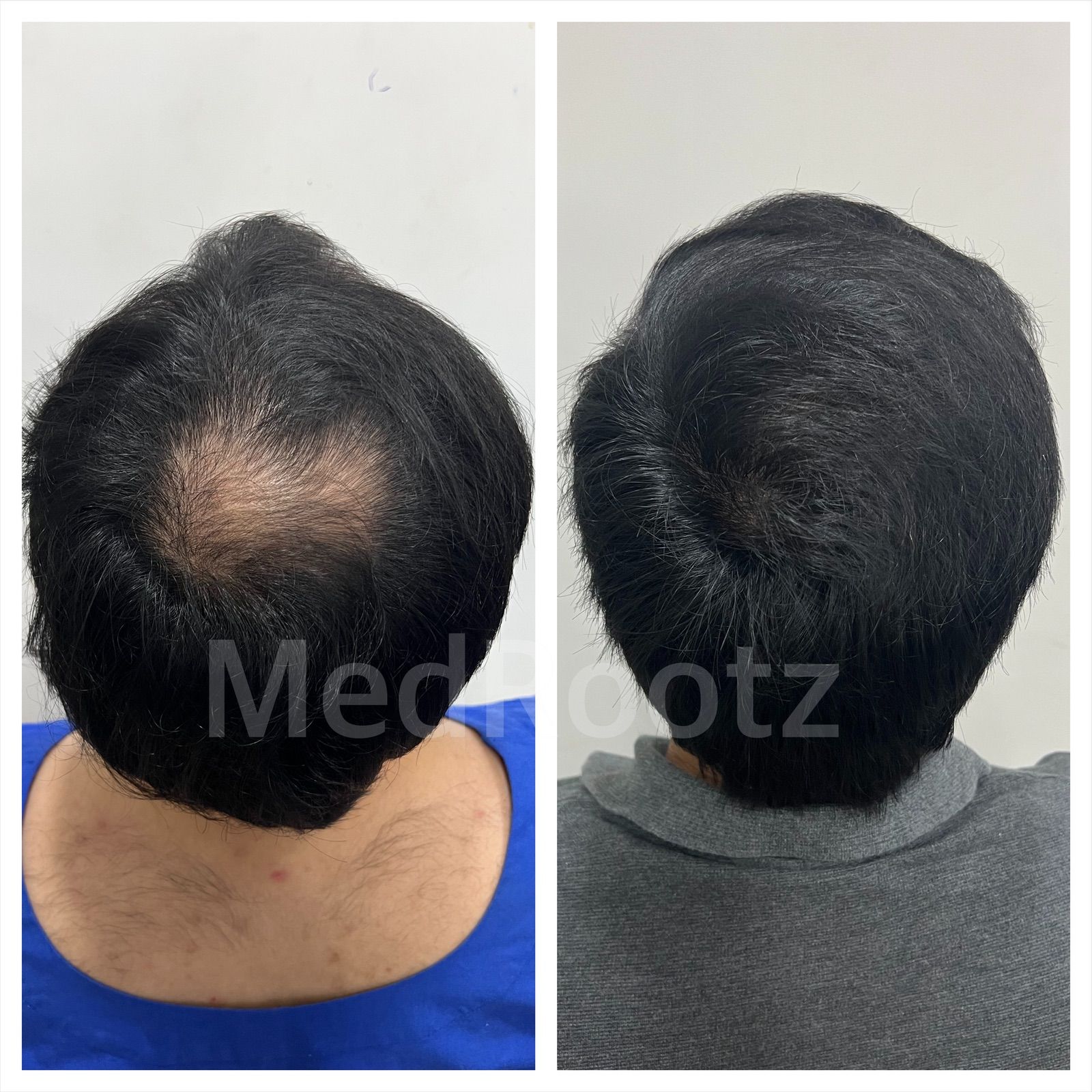 Nu-FUE crown area hair transplant before and after