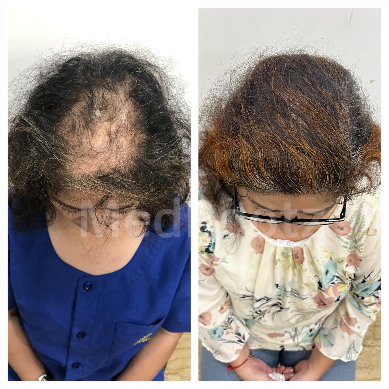 Female hair transplant before and after from MedRootz gallery
