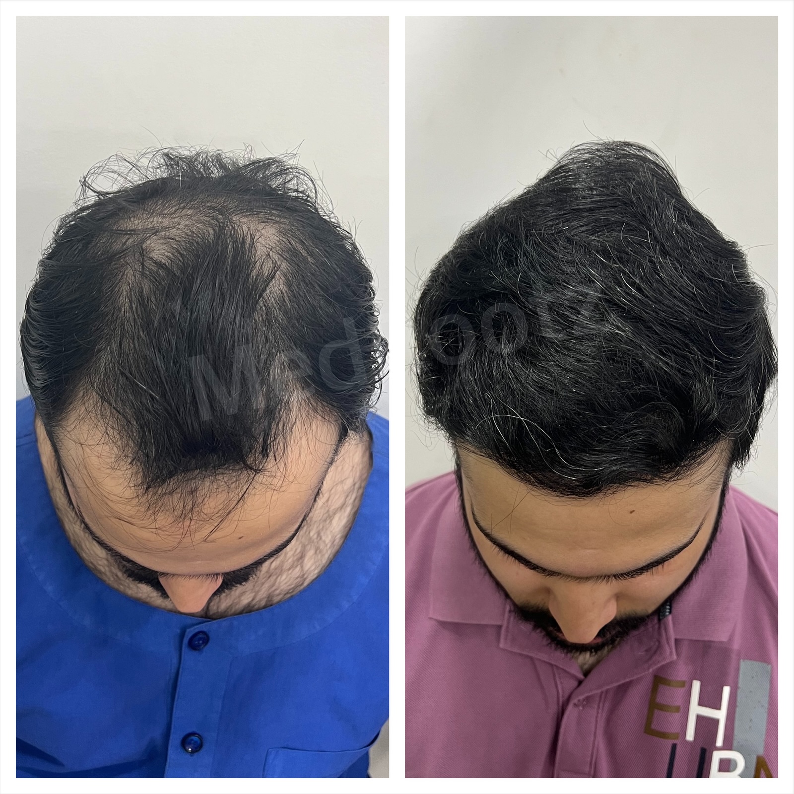 Nu-FUE hair transplant before and after, 4546 grafts