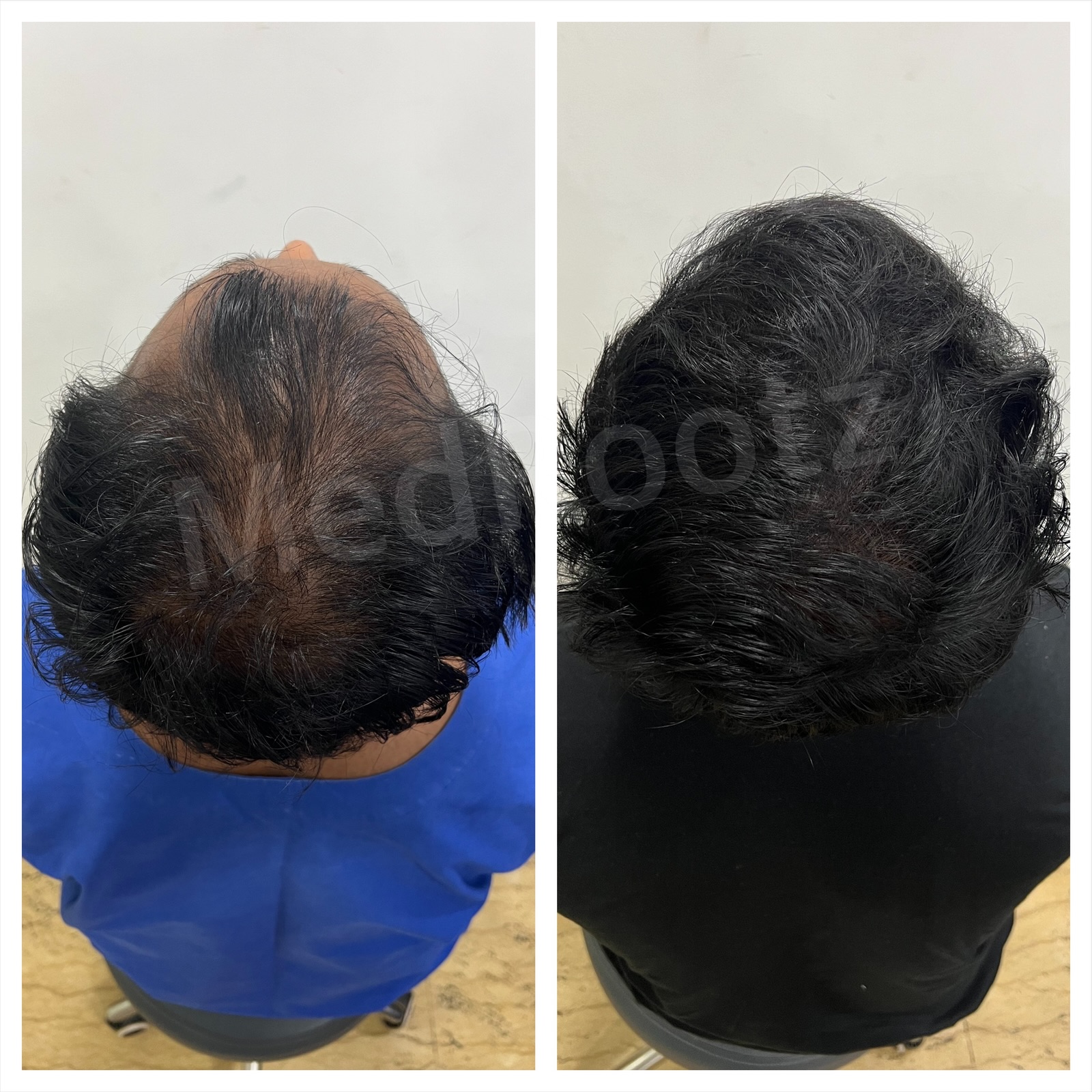 Hair transplant consultation and restoration at MedRootz