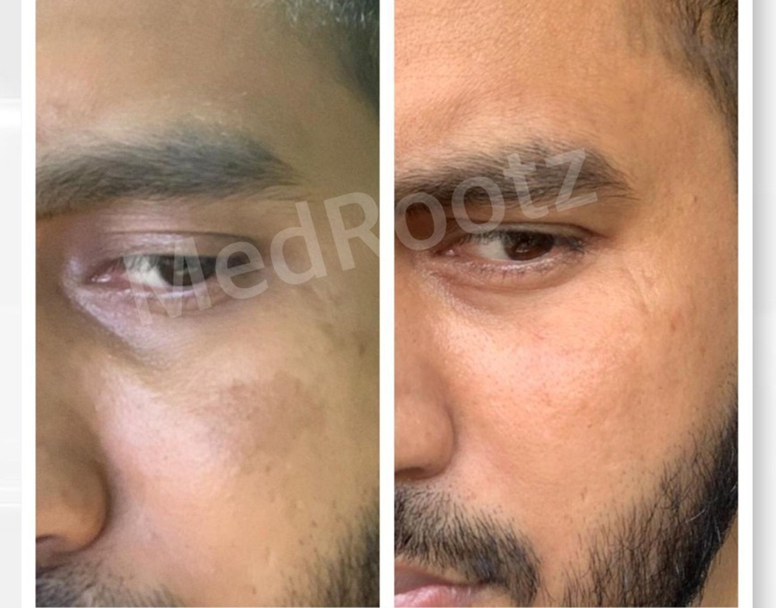 Laser treatment at MedRootz Hair & Skin Clinic