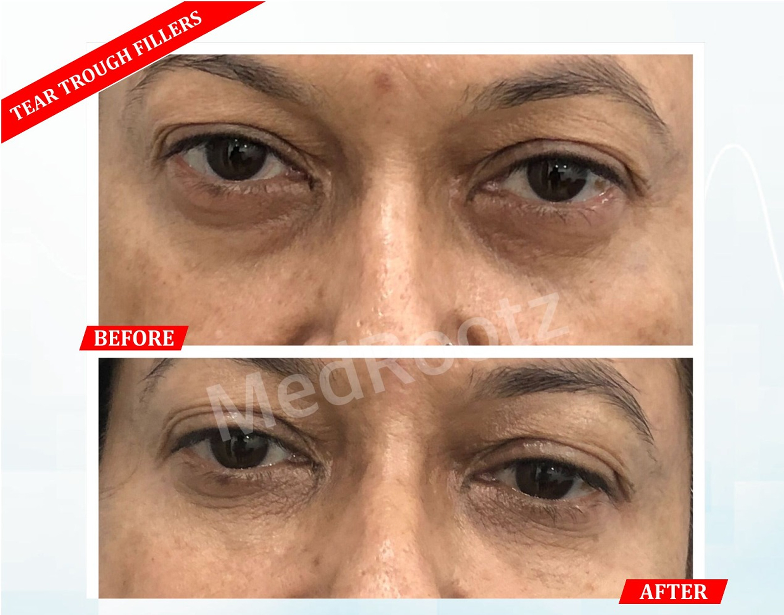 Non-surgical voluminous hair treatment at MedRootz